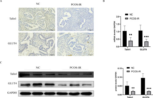 Figure 1. Expression and localization of Talin1 and GLUT4 in endometrium of PCOS-IR and control patients. (A) Localization of Talin1 and GLUT4 in the endometrium; (B, C) mRNA and protein levels of Talin1 and GLUT4 in endometrium of PCOS-IR and control patients. **p < 0.01, ***p < 0.001.