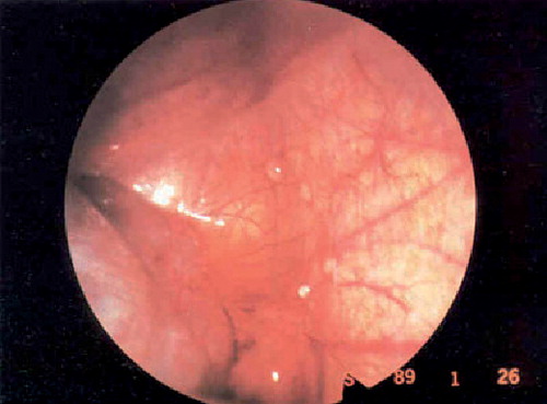 Figure 6. Clear endometriosis.Reprinted from Citation[122].