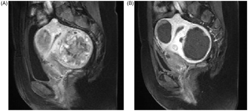 Figure 4. A sagittal plane of contrast enhanced MRI obtained from a 43-year-old patient with multiple uterine fibroids before and 1 day after HIFU treatment. (A) pre-HIFU image showed multiple uterine fibroids with poor to medium blood supply; (B) post-HIFU image showed the multiple uterine fibroids were completely ablated without damaging to the normal structures of the uterus.