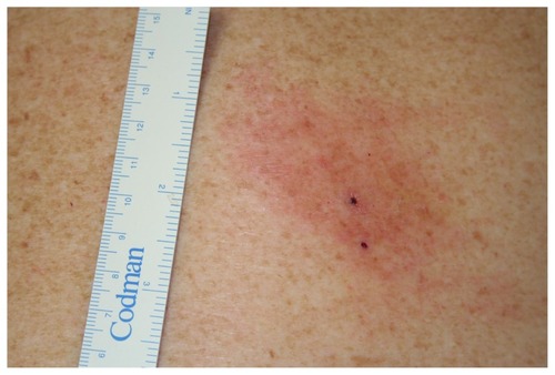 Figure 2 Erythema migrans patient A at day 6.