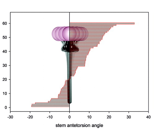 Figure 2. Range of stem torsion in 60 hips.
