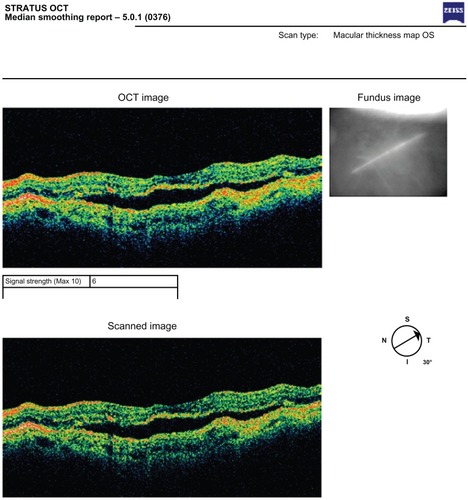 Figure 4 OCT image – active exudative ARMD.