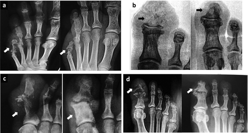 Figure 3. Osteomyelitis before and after PDT. X-Ray images obtained from patients with osteomyelitis before and after PDT treatment. A, B, C, and D are X-ray images from four patients treated with PDT. Arrows at left are showing osteomyelitis in metatarsal and phalanges before treatment with cortical disruption and pathological destruction or disappearance of bone tissue. Arrows at right represent the same patients after PDT. Note the effective regeneration of diseased bones after PDT. A and B were obtained from patients of the DP group, C and D from the NDP group.