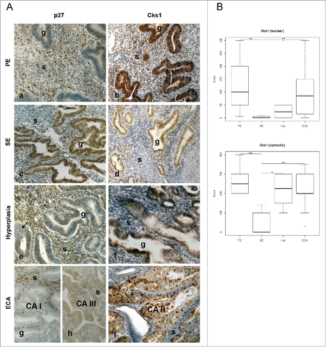 Figure 6. Immunohistochemical analysis of normal, hyperplastic, and type I endometrial (endometrioid) cancer tissues shows inverse expression of p27 and Cks1. (A) Tissues from normal proliferative (PE; panels a-b) and secretory (SE; c-d) endometrium, endometrial hyperplasia panels (HYP; e-f), and ECA (panels g-i) were immunostained for Cks1 or p27. The samples were scored as described in Materials and Methods. (B) The box plot represents nuclear and cytosolic immunoreactivity scores for Cks1 in normal PE (n = 7) and SE (n = 5), HYP (n = 10), and ECA (n = 22). Immunostaining scores for p27 were previously reported.Citation1 The Kruskal-Wallis nonparametric tests were performed to assess the difference in Cks1 values (nuclear and cytosolic) across disease category followed by Dunn's Test for multiple comparisons (* P ≤ 0.05, ** P ≤ 0.01. g = Gland; s = stromal cells). Magnification for all is 10×. To improve visual matches of photos of slides, panel d was adjusted to remove excessive pink color.