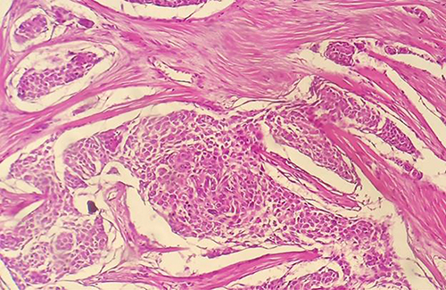 Figure 8 Microscopic picture on 40/HPF showing whorls and syncytium of oval to spindle meningothelial cells.