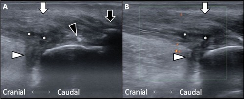 Figure 1 (A) Achilles tendon swelling with partial tear. (B) Increased blood flow as revealed with orange dots under power Doppler views. Asterisks, tear site; black arrowhead, calcified lesions; white arrowhead, retrocalcaneal bursa; black arrow, spurs; white arrow, Achilles tendon.