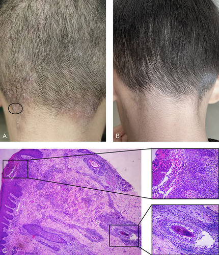 Figure 1 (A) At the initial visit, multiple papules, and pustules of 1–3 mm in diameter were detected at the base of the erythema of the head, and the occipital lesions merged into plaques. The black circle was the site of the biopsy. (B) After 3 months of the treatment (during follow-up), no obvious lesion or pigmentation was observed. (C) Mild thickening of the epidermis, eosinophil and neutrophil infiltration around the hair follicle, diffuse eosinophil and neutrophil infiltration in the dermis, and the pustule under the stratum corneum (HE×100). (D) Pustule was found in the stratum corneum (HE×200). (E) Abundant eosinophil infiltration was mentioned around the hair follicle and inside the hair follicle (HE×200).