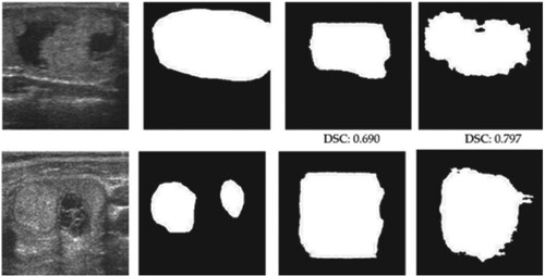 Figure 11. Gives the segmented result of the thyroid lung nodule.