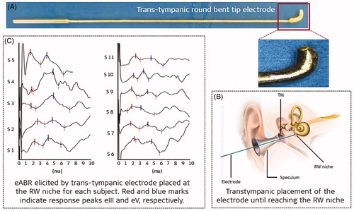 Figure 26. Transtympanic rounded-bent tip electrode that facilitates easy placement at the RW niche (A). Illustrative representation of the transtympanic electrode placement at the RW niche (B). PromStim eABR responses for all 11 patients (C) [Citation27] (image courtesy of MED-EL).