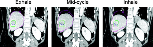 Figure 2.  4-D CT with IV contrast for patient with liver metastases treated during free breathing. Full exhale reconstruction (used for radiation planning), mid cycle and inhale reconstructions displayed. The gross tumour volume (GTV) and liver contour from the exhale reconstruction are shown in blue and pink respectively. The internal target volume (ITV) made from the exhale and inhale phase GTV reconstructions is displayed in green, partially overlapping the exhale phase GTV. An additional 5 mm PTV margin is added to the ITV for setup error.