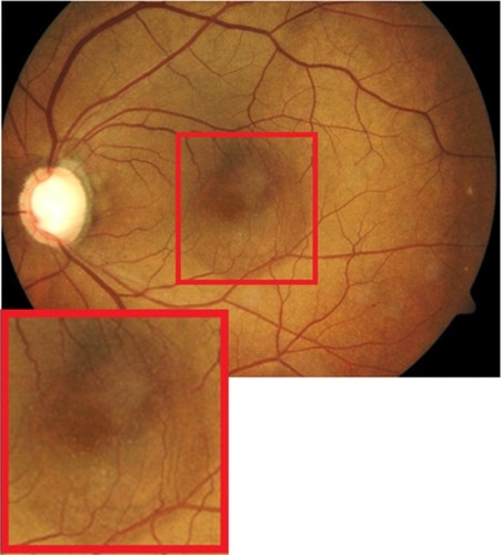Figure 7 Fundus photograph of the left eye showing edema residues inside the area of CSC (enlarged).