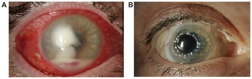 Figure 1 Case 2. (A) The patient’s clinical condition, following 3 weeks of treatment with topical and oral antibiotics, with severe corneal infiltrate and hypopyon. (B) The patient’s eye 4 months after initial presentation, with a clear corneal graft and a quiet eye.