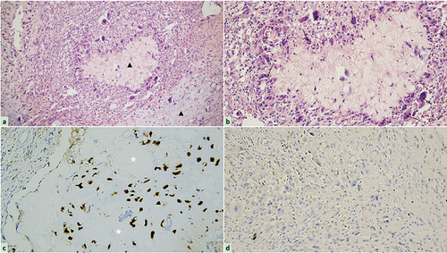 Figure 6. Photomicrograph of the tumor following hematoxylin-eosin staining and immunohistochemistry. (a) The cellular components are less prominent in cartilage matrix and mucoid (black triangle, original magnification × 200), but myofibroblastic-like spindle cell proliferation with loosely arranged myxoid stroma, minimal cellular atypia, and rare mitoses, along with storiform or fascicular pattern can be observed in the remaining areas; (b) a small amount of multinucleated giant cells (black arrow, original magnification × 400) admixed with plentiful mononuclear spindle cells surrounding clear mucus and cartilage matrix forming a pathologic lobular structure; (c) immunohistochemical staining is positive for S-100 in the chondrocytes (white asterisk, original magnification × 200) (d) but negative for Ki-67 in all kinds of cells (less than 1% positive).