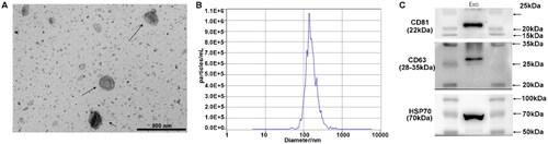 Figure 1. Characteristics of isolated exosomes. Serum exosomes were isolated from LC patients with recurrence before and after microwave ablation (MWA). (A) Electron micrograph observation. (B) Size distribution of the exosomes. (C) Western blot for exosome markers of CD81, CD63 and HSP70. The isolated vesicles were consistent with the characteristics of exosomes, indicating that exosomes were successfully isolated.