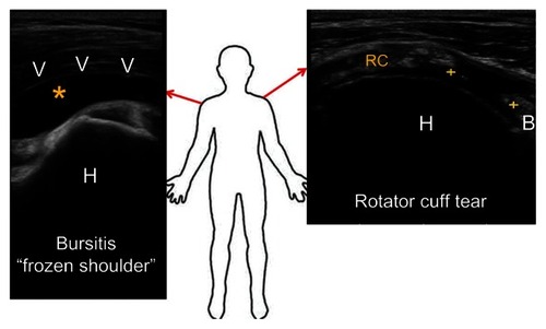 Figure 1 Typical ultrasound images of frozen shoulder and rotator cuff tear.