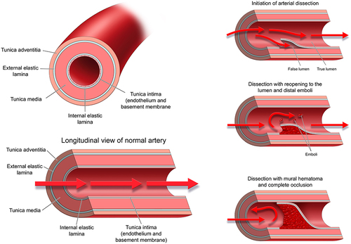Figure 1 Normal blood vessel structure, flow patterns (depicted with red arrows) and mechanism dissection and related embolism.
