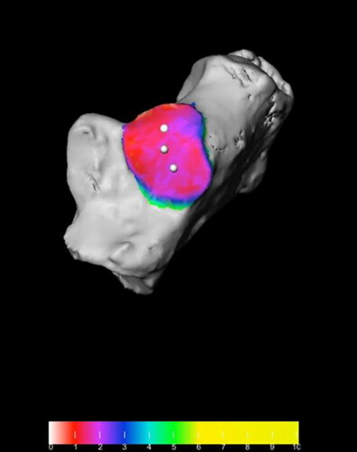 Figure 1. The posterior talo-calcaneal (PTC) joint facet marked on 3 D reconstruction image of calcaneus (the color indicates the shortest distance (in mm) to the corresponding structure of the talus). The same color scale was used for every observation.A color scale of the distances was used in place of a color scale of the angles, to avoid influencing observer decision.