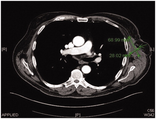 Figure 7. CT scan image 3-month post-resection of chronic seroma capsule showing almost complete resolution.