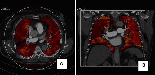 Figure 1 (A) Dual-energy CT axial image in a patient with chest pain and shortness of breath. Color-coded perfusion map demonstrates a wedge-shaped perfusion defect in the right lower lobe, coupled with an opacification defect of the proximal interlobar pulmonary artery in the weighted average CT mediastinal image. Small emboli can be seen in the left arterial pulmonary branches without parenchyma perfusion defects. (B) Dual-energy CT coronal multiplanar reconstruction in a patient with dyspnea. Color-coded perfusion map shows patchy area of reduced perfusion in the upper and lower right lobe; a weighted average CT image in the mediastinum demonstrates an incomplete obstruction of the upper and lower pulmonary artery. Minimal thrombotic obstructions in the left main pulmonary artery without perfusion alterations in the left lung can be appreciated.