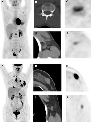 Figure 6 Representative images. (A–E): A 31‐year‐old female patient with HR+/HER2- MBC underwent PET/CT scan (A, maximum intensity projection image). We detected that the first lumbar vertebra lesion had the highest 18F‐FDG uptake in all metastatic lesions (B, CT image; C, PET image, SUVmax were 5.43), whereas the right axillary lymph node lesion had the lowest uptake (D, CT image; E, PET image, minimum FDG uptake across all lesions = 3.58). Therefore, HI of this patient was 1.52, and she had a median PFS of 57.4 months. (F–J): A 30‐year‐old female patient with HR+/HER2- MBC underwent 18F‐FDG PET/CT scan (F, maximum intensity projection image). We detected that the chest wall lesion had the highest 18F‐FDG uptake in all metastatic lesions (G, CT image; H, PET image, SUVmax = 15.71), whereas right axillary lymph node lesion had the lowest uptake (I, CT image; J, PET image, minimum FDG uptake = 3.79); Therefore, HI of this patient was 4.15, and she had a PFS of 5.2 months.