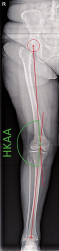 Figure 1. Measurement of the Hip–knee–ankle angle on full limb radiograph. The hip–knee–ankle angle (HKAA, in green) is measured between 2 axes (in red). One axis runs from the middle of the femoral head to the middle of the femoral notch, and a second axis from the middle of the tibial notch to the middle of the talar head.Definitions of the femoral axis from left to right (top):Fem1—mid-shaft at approximately 10 cm proximal of the femoral notch + mid-shaft in the area where the meta- and epiphysis meet (van Raaij et al. Citation2009, Iranpour-Boroujeni et al. Citation2014, Zampogna et al. Citation2015).Fem2—mid-shaft at approximately 10 cm proximal of the femoral notch + center of the femoral notch (Felson et al. Citation2009, van Raaij et al. Citation2009, McDaniel et al. Citation2010, Sheehy et al. Citation2011).Fem3—mid-shaft at approximately 10 cm proximal of the femoral notch + base of the tibial spines (Kraus et al. Citation2005, Hinman et al. Citation2006, Issa et al. Citation2007, McDaniel et al. Citation2010, Navali et al. Citation2012, Iranpour-Boroujeni et al. Citation2014, Zampogna et al. Citation2015).Fem4—mid-shaft at approximately 10 cm proximal of the femoral notch + middle of tibial plateau (McDaniel et al. Citation2010).Definitions of the tibial axis from left to right (bottom):Tib1—mid-shaft at approximately 10 cm distal of the base of the tibial spines + mid-shaft in the area where the meta- and epiphysis meet (van Raaij et al. Citation2009, Iranpour-Boroujeni et al. Citation2014, Zampogna et al. Citation2015).Tib2 Mid-shaft at approximately 10 cm distal of the base of the tibial spines + center of the femoral notch (McDaniel et al. Citation2010).Tib3—mid-shaft at approximately 10 cm distal of the base of the tibial spines + base of the tibial spines (Kraus et al. Citation2005, Hinman et al. Citation2006, Issa et al. Citation2007, Colebatch et al. Citation2009, van Raaij et al. Citation2009, McDaniel et al. Citation2010, Sheehy et al. Citation2011, Navali et al. Citation2012, Iranpour-Boroujeni et al. Citation2014, Zampogna et al. Citation2015).Tib4—mid-shaft at approximately 10 cm distal of the base of the tibial spines + middle of tibial plateau (McDaniel et al. Citation2010).The 2 pictures on the left show the measurement of the FTA using method 2 for the femoral axis and method 1 for the tibial axis on a standard AP knee radiograph from the present data set.