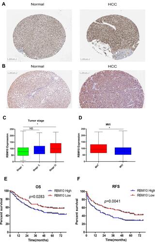 Figure 7 Expression characteristics of RBM10 and its prognostic value in our HCC cohort revealed by IHC test. (A) RBM10 protein is over-expressed in HCC by IHC in the HPA website; (B) RBM10 protein is over-expressed in HCC by IHC in our HCC cohort; (C) Elevated expression of RBM10 correlated to advanced TNM stage (n1=82, ±S 83.62±48.36; n2=125, ±S 89.37±42.53; n3=34, ±S 105.08±51.77;*p = 0.023); (D) Elevated expression of RBM10 correlated to positive status of MVI (nMVI+=88, ±S 98.12±5.20; nMVI-=153, ±S 84.75±3.57; *p = 0.03); (E) Up-regulation of RBM10 is correlated with a dismal OS in our HCC cohort (No. of high expression patients=120, median OS 47 months; No. of low expression patients=121, median OS 57 months, p = 0.0283); (F) Up-regulation of RBM10 predicts a dismal DFS in our HCC cohort (No. of high expression patients=120, median DFS 19 months; No. of low expression patients=121, median DFS 50 months; p = 0.0041). *represents p < 0.05.