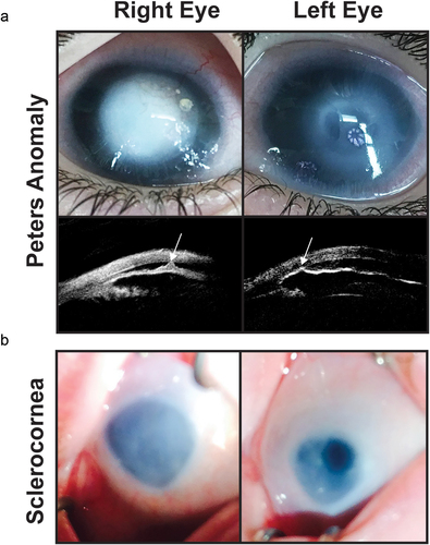 Figure 4. Congenital corneal opacities. (a) Bilateral peters anomaly with a denser opacity in the right eye than the left eye. Ultrasound biomicroscopy demonstrates iridocorenal adhesions in the area of the corneal defect (white arrows). (b) Sclerocornea with microphthalmia showing a small hazy cornea with unclear demarcation of the limbus. The left eye has a superior iris opening which underlies an area of clearer cornea.