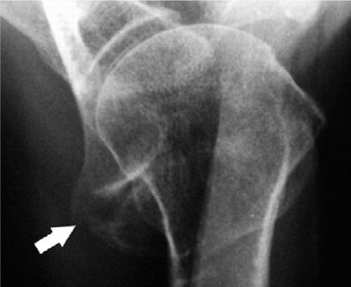 Figure 1c. Axillary radiograph of a right shoulder with an os meta-acromiale. The white arrow indicates the non-ossified gap between the os meta-acromiale and the acromion.