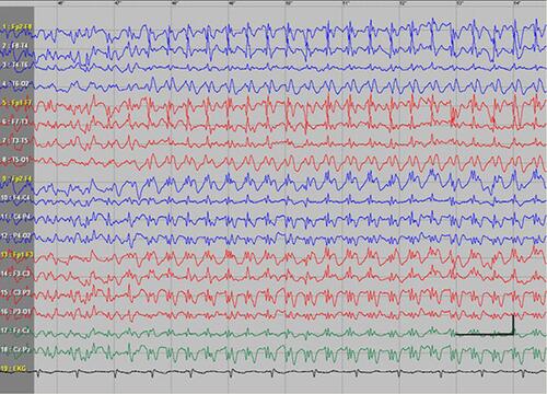 Figure 2 Absence status epilepticus in patient 1. Vertical bar - 100uV, horizinatl bar - 1 sec.