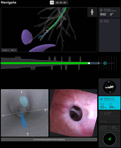 Figure 5 Ion system interface displaying endobronchial, virtual bronchoscopic views, navigational pathway, pleural margins, and distance to target.