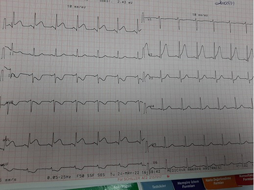 Figure 1 ECG pattern of patient with large diagonal branch (D1) occlusion. ≥10mm T wave and ST elevation in lead V2; ST elevation lead I and aVL; and ≥2 mm ST depression lead III.