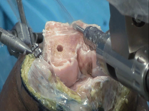 Figure 6. The robot milled the femoral volumes with a high-speed milling tool attached to its arm. Better surface quality of femoral or tibial bone cuts can be achieved using high-speed milling cutters attached to robotic arms than with oscillating saws.