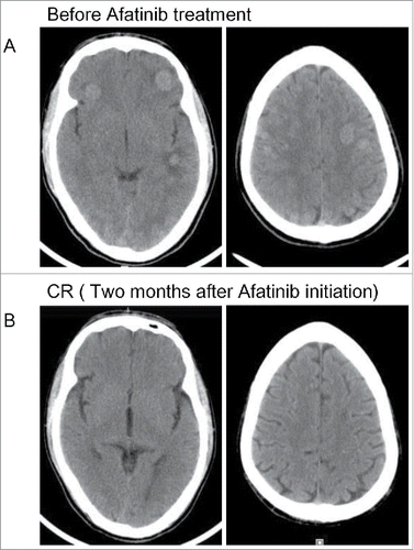 Figure 2. Head computed tomography scan revealed the tumor response to afatinib. (A) The progressive disease status of intracranial lesions before afatinib treatment. (B) Complete response of intracranial lesions after afatinib treatment.