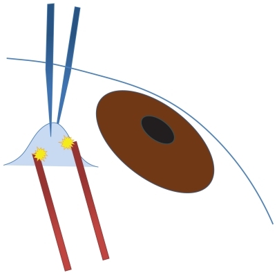 Figure 1 Schema of conjunctival coagulation. The operator instructs the patient to gaze upward and picks up the conjunctiva using hook forceps (red). The tissue was coagulated using coagulation forceps (blue) and minimal electrical power. Yellow bursts indicate coagulation.