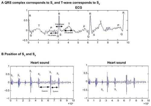 Figure 2 (A and B) Relationship of ECG and the four heart sounds.Abbreviation: ECG, electrocardiogram.