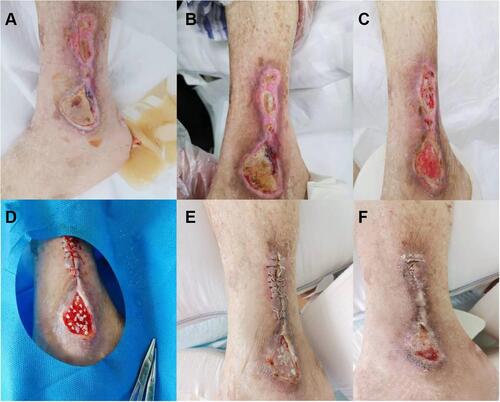 Figure 3 Typical case III. (A) Chronic wound near the lateral malleolus of the lower leg. (B and C) Debridement and dressing change regularly. (D) No obvious scar hyperplasia was found and the wound healed basically. (E) After the wound was basically cleaned, the wound that could be sutured proximal was sutured. (F) No obvious scar hyperplasia was found and the wound healed basically.