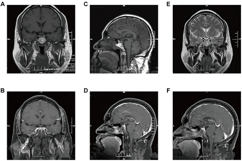 Figure 1 Sagittal and coronal slices of the pituitary MRI (A) Precontrast T1-weighted coronal slices MRI image. (B) Postcontrast T1-weighted coronal slices MR image. (C) Precontrast T1-weighted sagitta slices MRI image. (D) Postcontrast T1-weighted sagitta slices MR image. (E) Precontrast T2-weighted coronal slices MRI image. (F) Postcontrast T2-weighted sagitta slices MR image.