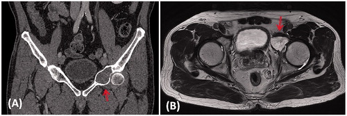 Figure 1. (A) A coronal CT image and (B) an axial T2-weighted MR image in a patient with a low grade chondrosarcoma involving the anterior column of left acetabulum (red arrows).