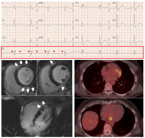 Figure 2. Patient with conduction disorders in Cardiac Sarcoidosis. ECG showing second degree atrioventricular block 2/1. Cardiac magnetic resonance imaging showing patchy mid-wall and subepicardial late gadolinium enhancement (LGE) involving the infero-basal, infero-septal-apical and antero-basal segments of the left ventricle compatible with myocardial fibrosis. Positron emission tomography (PET) showed infero-basal and antero-basal myocardial 18 F-Fluorodoxyglucose uptake (From reference [Citation33]).