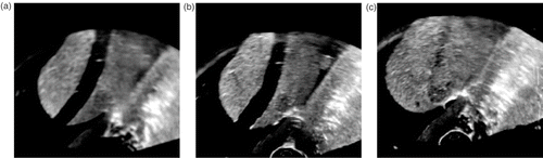 Figure 3. Example of image-based motion compensation. (a) Real-time ultrasound. (b) Registration result of (a) in the reconstructed reference ultrasound volume. (c) Initial starting point of the registration.