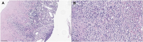 Figure 1 The histopathological findings of the lymph node biopsy. (A) Inflammatory necrosis with granulomatous formation. Magnification, x200. Hematoxylin and eosin staining. (B) Inflammatory necrosis with granulomatous formation. Magnification, x400. Hematoxylin and eosin staining.