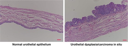 Figure 6 Microscopic images of normal urothelial epithelium and urothelial dysplasia/carcinoma in situ. Scale bar 200 µm.