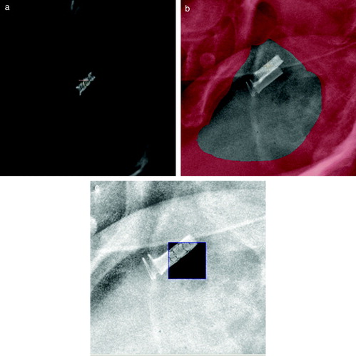 Figure 5.  Work around method for automated match of the DS-II stent in Exactrac. a) the DRR image constructed from the planning CT scan. The look up table (LUT) is changed to show the most dense parts only b) The combined DRR and x-ray image before match. Notice the difference in position of the stent. Red areas are bony structures that are masked out on the DRR image. c) The combined DRR and the x-ray image after matching. The small inserted window (spy-glass) demonstrate that the stent on DRR and x-ray now overlays.