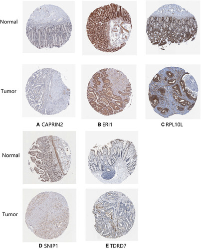 Figure 8 Verification of hub RNA-binding protein (RBP) expression in colon adenocarcinoma (COAD) tissues and normal colon tissues using the Human Protein Atlas (HPA) database. (A) CAPRIN2, (B) ERI1, (C) RPL10L, (D) SNIP1 and (E) TDRD7.