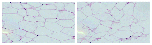 Figure 2. H&E stained images of tumor-adjacent and distant adipose tissue from a patient with invasive breast cancer. The image on the left is adipose tissue adjacent to an ER+/PR−/HER2−, moderately-differentiated IDCA. The image on the right is distant adipose tissue located 4 cm from the tumor.