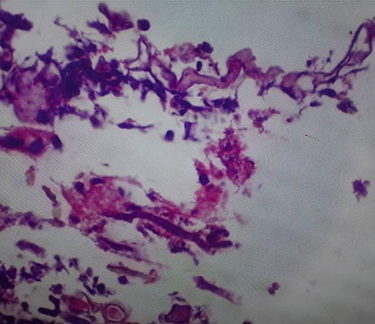 Figure 4 The smear shows fungal hyphae with broad based non-septate hyphae stained with H&E stain.