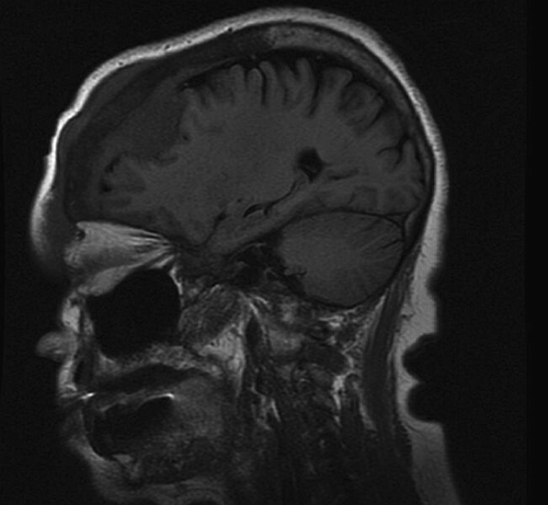 Figure 1.  CT scan demonstrating soft tisue mass within right frontal bone with intracranial and extracranial extension.