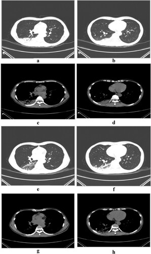 Figure 3. Serial chest computed tomography (CT) scans of the 46-year-old male with psittacosis pneumonia (the third patient). The initial CT scan (3 days after the onset) shows consolidations with bronchograms in the right lower lobe (a, b, c, d). The follow-up CT scan (13 days after the onset) shows the area of consolidation in the right lower lobe has decreased obviously (e, f, g, h).