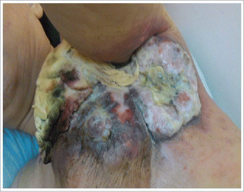 Figure 1. The appearance of a breast tumor before radiotherapy.