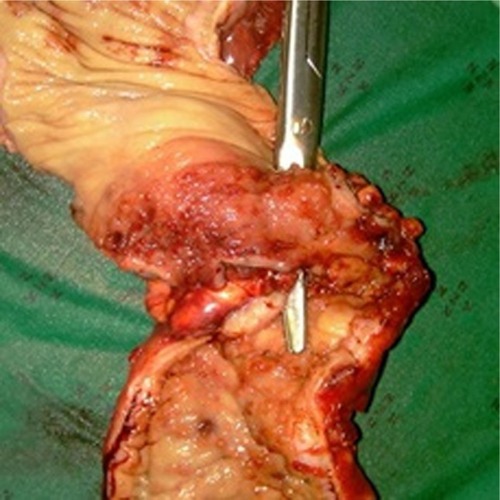 Figure 4 Left colonic specimen with instrument outlining site of perforation.